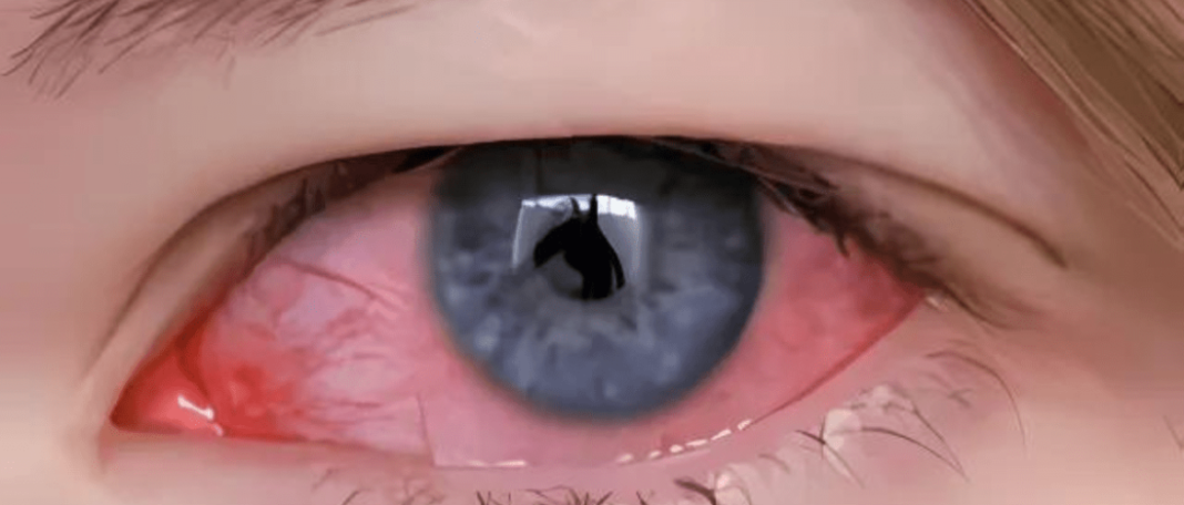 what does pink eye look like