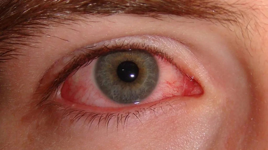 how long is pink eye contagious