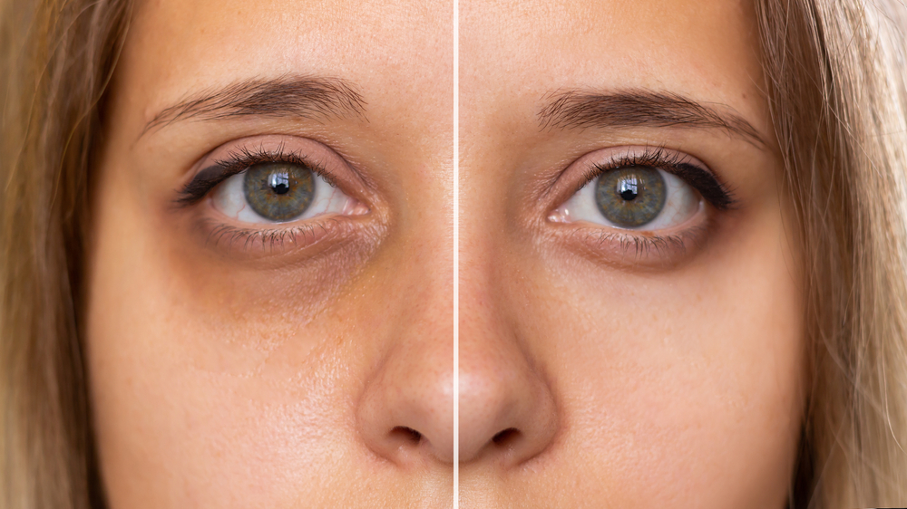 how to remove eye bags permanently